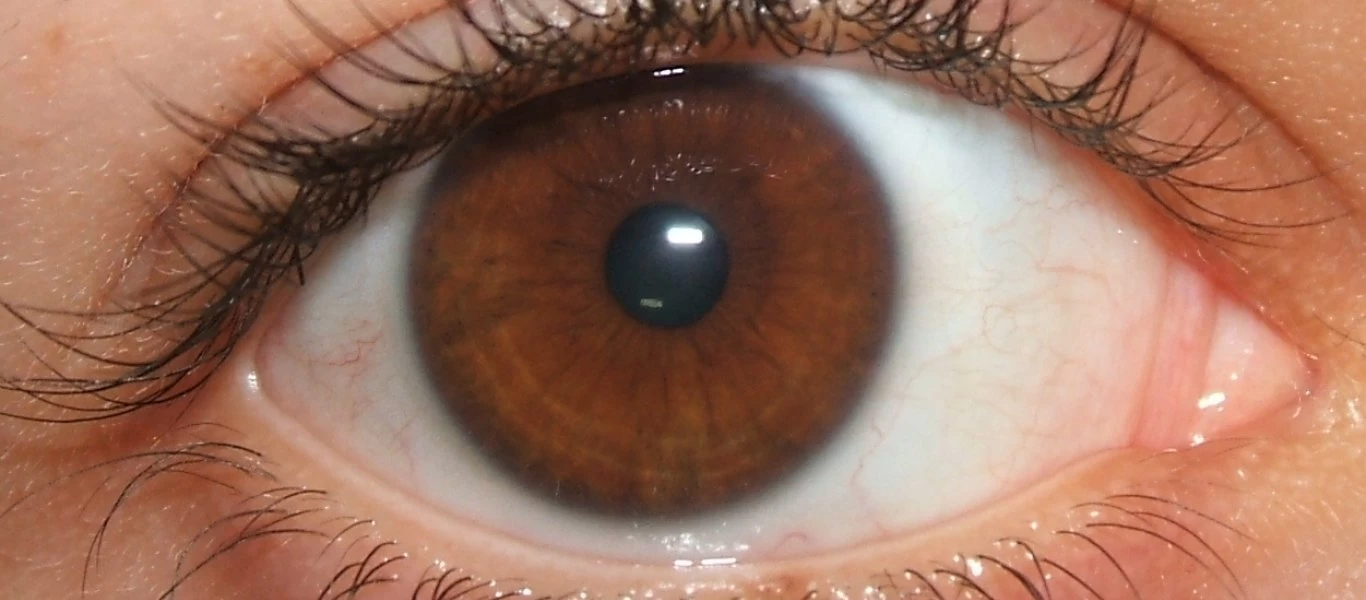 Σε ποιες περιπτώσεις αλλάζει το χρώμα των ματιών;